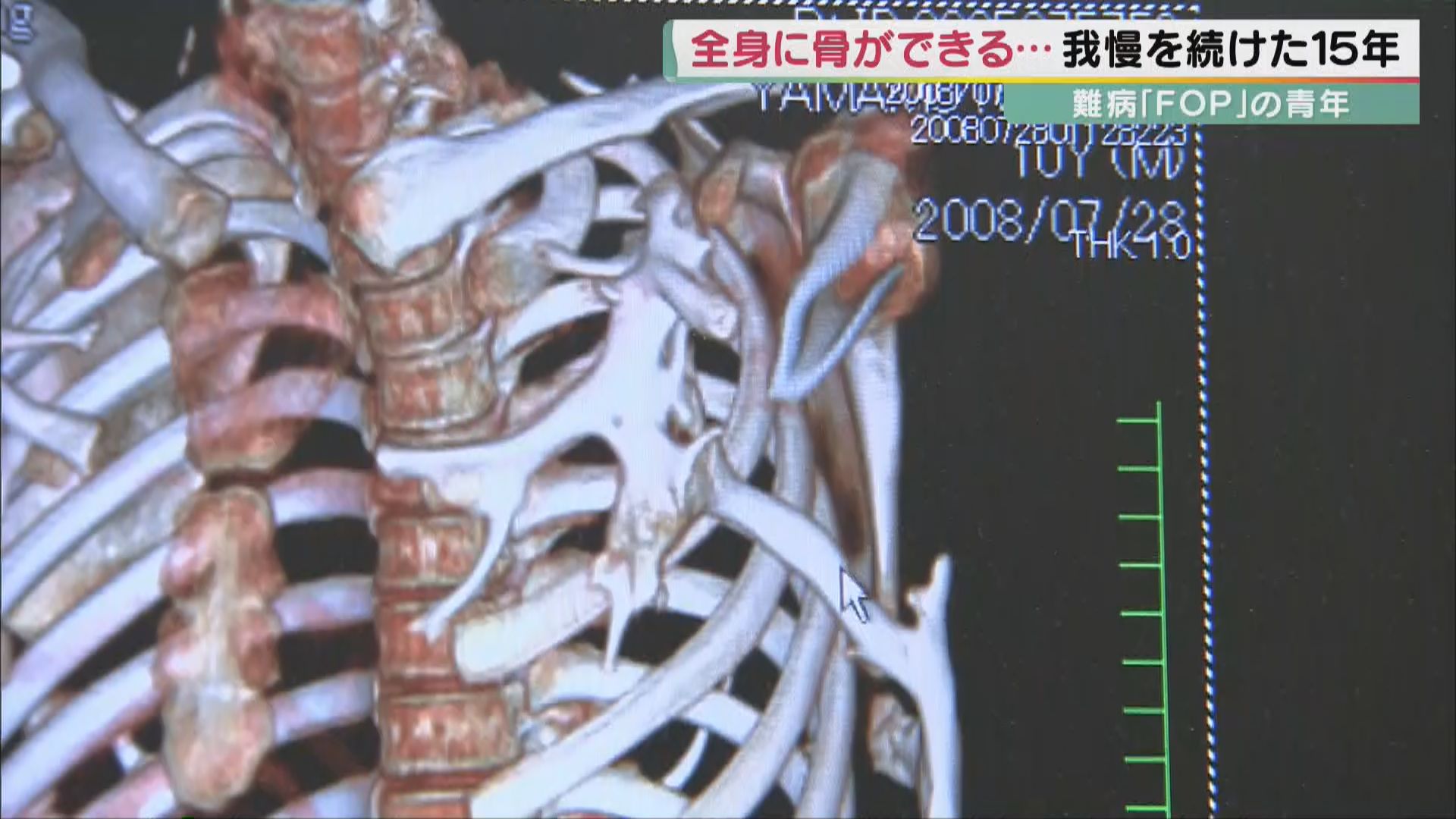 全身の筋肉に骨が…難病「fop」と15年以上闘い続ける青年 体への衝撃がリスク…虫歯の治療も“命がけ” 自らの皮膚を研究に提供 Ips細胞を活用した治療法“一筋の光”に 育海さんが“いま”願う